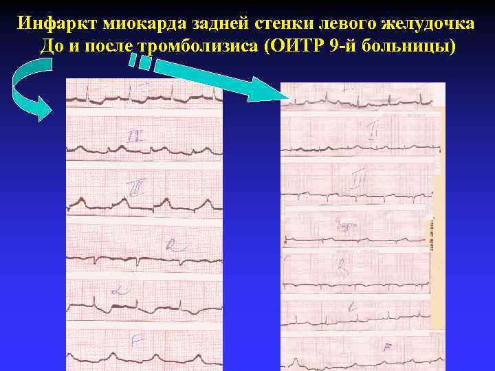 Инфаркт миокарда задней стенки левого желудочка До и после тромболизиса (ОИТР 9 -й больницы)