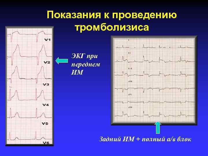 Показания к проведению тромболизиса ЭКГ при переднем ИМ Задний ИМ + полный а/в блок