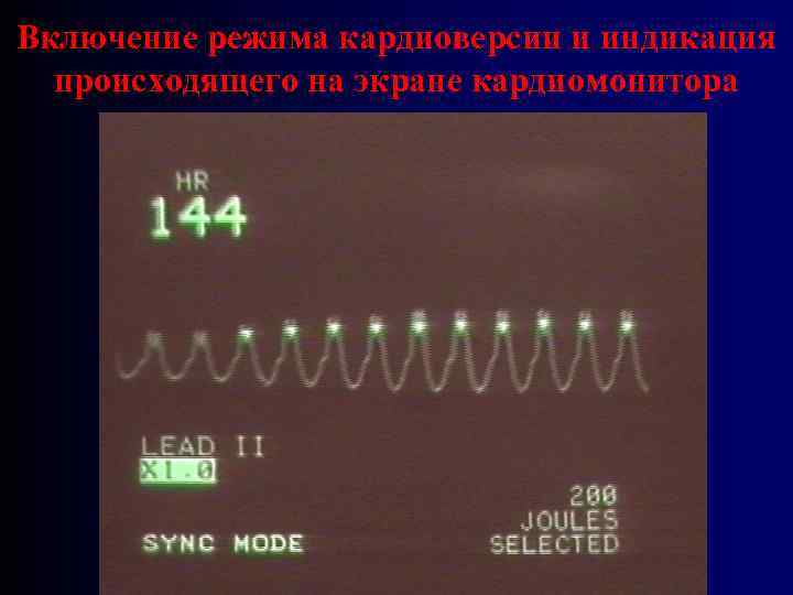 Включение режима кардиоверсии и индикация происходящего на экране кардиомонитора 