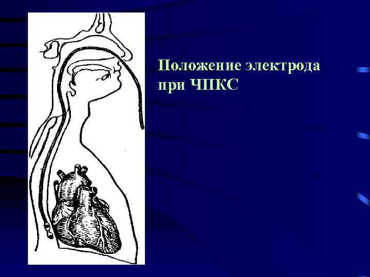 Положение электрода при ЧПКС 