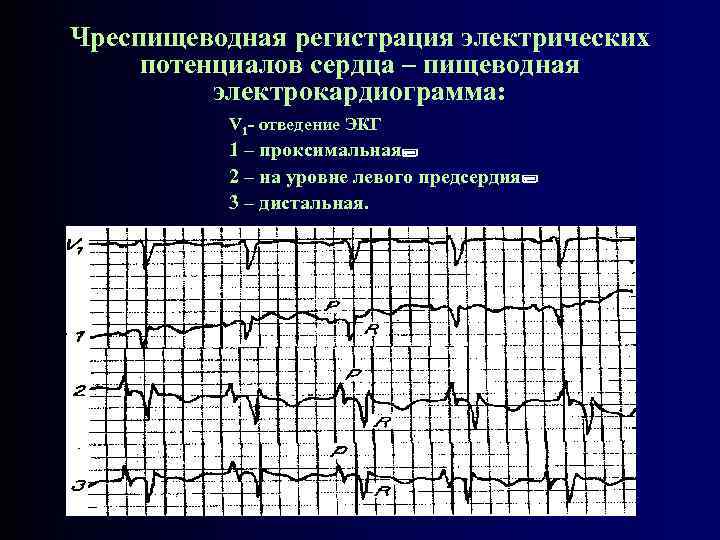 Чреспищеводная регистрация электрических потенциалов сердца – пищеводная электрокардиограмма: V 1 - отведение ЭКГ 1