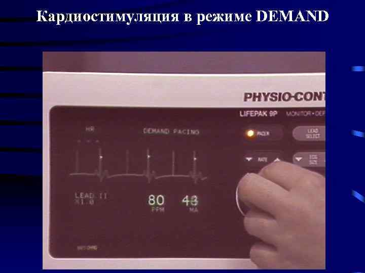 Кардиостимуляция в режиме DEMAND 