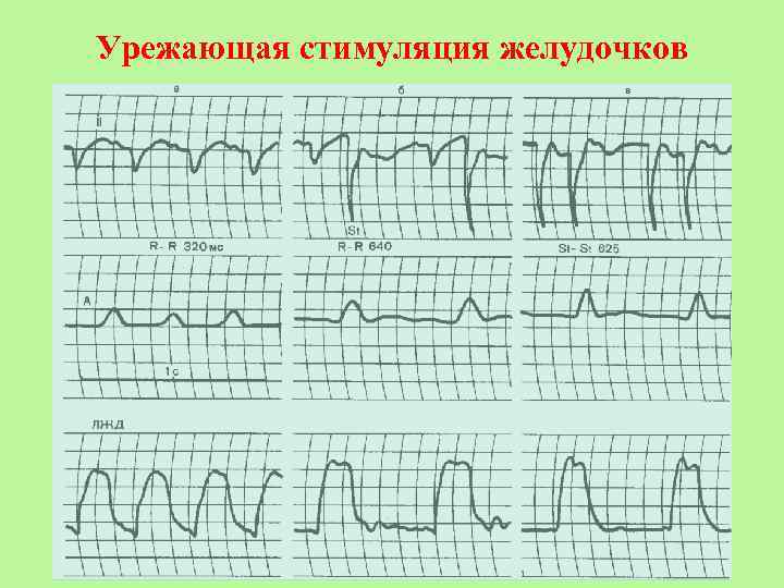 Урежающая стимуляция желудочков 