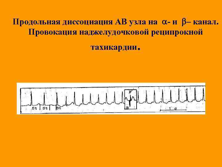 Продольная диссоциация АВ узла на - и – канал. Провокация наджелудочковой реципрокной тахикардии. 