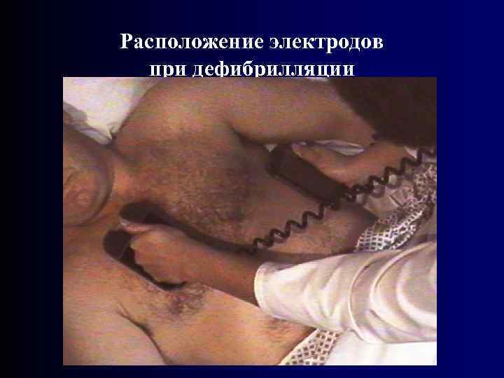 Расположение электродов при дефибрилляции 