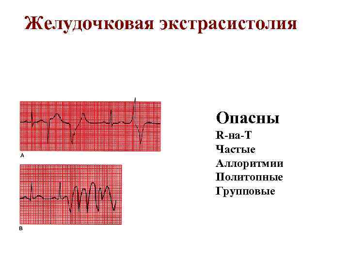 Желудочковая экстрасистолия Опасны R-на-T Частые Аллоритмии Политопные Групповые 