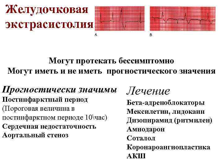 Желудочковая экстрасистолия Могут протекать бессимптомно Могут иметь и не иметь прогностического значения Прогностически значимы