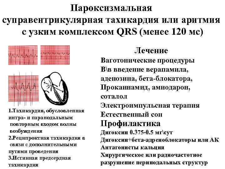 Пароксизмальная суправентрикулярная тахикардия или аритмия с узким комплексом QRS (менее 120 мс) Лечение 1.