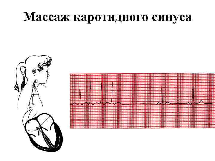 Массаж каротидного синуса фото