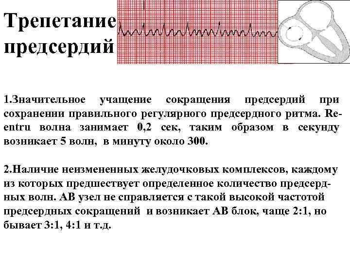 Трепетание предсердий 1. Значительное учащение сокращения предсердий при сохранении правильного регулярного предсердного ритма. Reentru