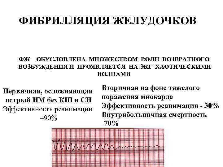 ФИБРИЛЛЯЦИЯ ЖЕЛУДОЧКОВ ФЖ ОБУСЛОВЛЕНА МНОЖЕСТВОМ ВОЛН ВОЗВРАТНОГО ВОЗБУЖДЕНИЯ И ПРОЯВЛЯЕТСЯ НА ЭКГ ХАОТИЧЕСКИМИ ВОЛНАМИ