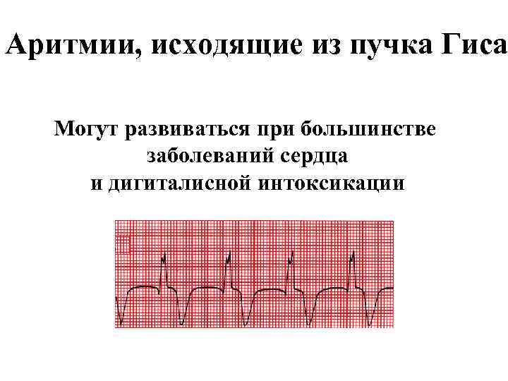 Аритмии, исходящие из пучка Гиса Могут развиваться при большинстве заболеваний сердца и дигиталисной интоксикации