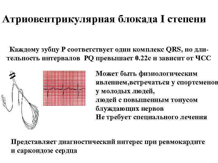 Атриовентрикулярная блокада I степени Каждому зубцу Р соответствует один комплекс QRS, но длительность интервалов