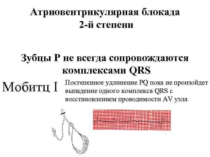 Атриовентрикулярная блокада 2 -й степени Зубцы Р не всегда сопровождаются комплексами QRS Мобитц I