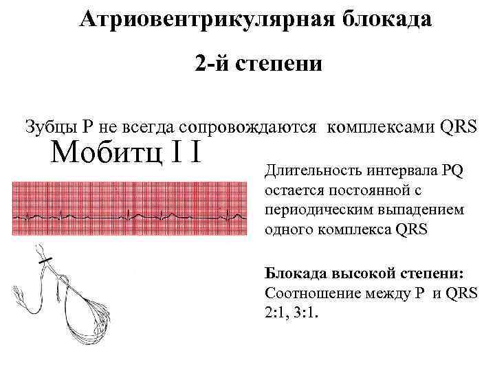 Атриовентрикулярная блокада 2 -й степени Зубцы Р не всегда сопровождаются комплексами QRS Мобитц I
