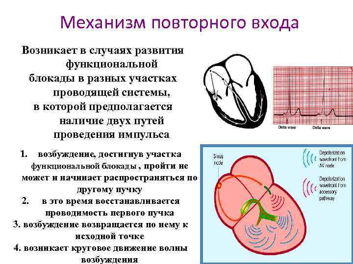 Механизм повторного входа Возникает в случаях развития функциональной блокады в разных участках проводящей системы,