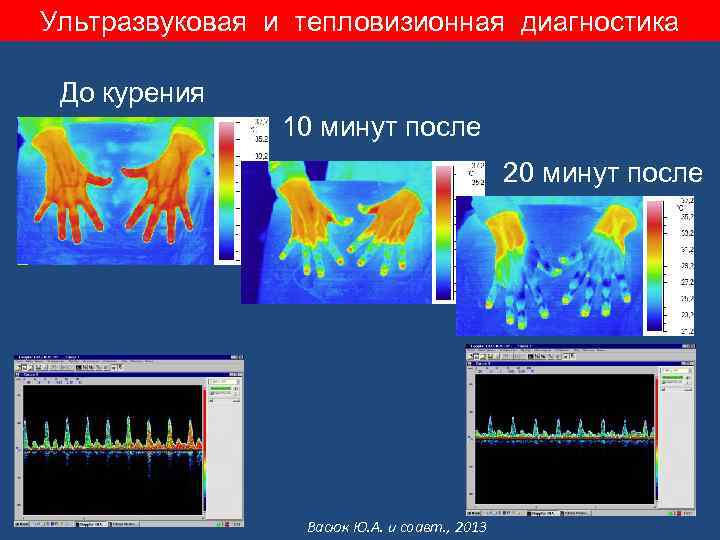 Ультразвуковая и тепловизионная диагностика До курения 10 минут после 20 минут после Васюк Ю.