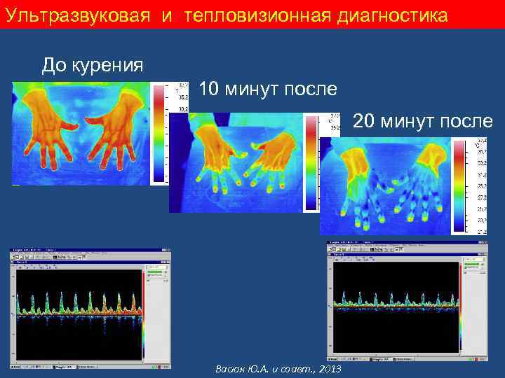 Ультразвуковая и тепловизионная диагностика До курения 10 минут после 20 минут после Васюк Ю.