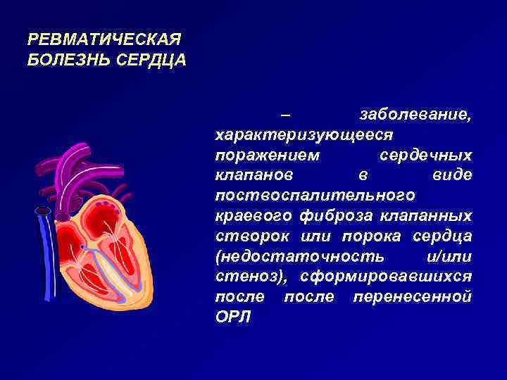 РЕВМАТИЧЕСКАЯ БОЛЕЗНЬ СЕРДЦА – заболевание, характеризующееся поражением сердечных клапанов в виде поствоспалительного краевого фиброза