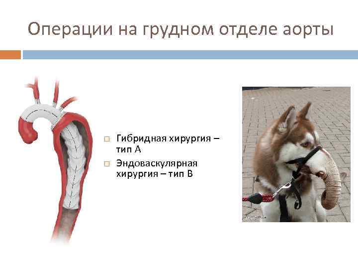 Операции на грудном отделе аорты Гибридная хирургия – тип А Эндоваскулярная хирургия – тип