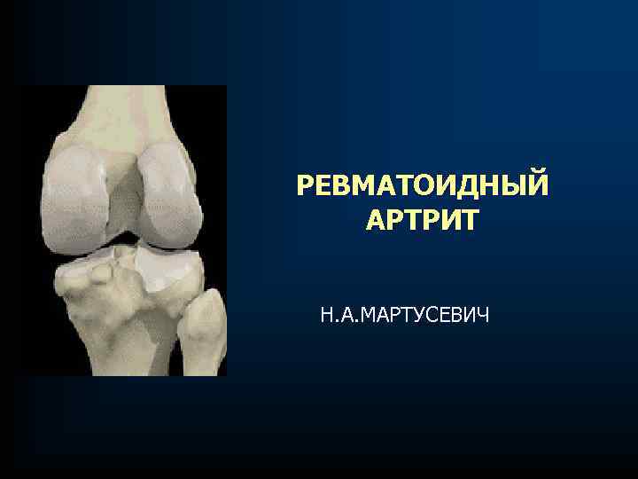 РЕВМАТОИДНЫЙ АРТРИТ Н. А. МАРТУСЕВИЧ 