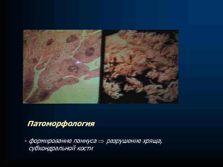 Патоморфология - формирование паннуса разрушение хряща, субхондральной кости 