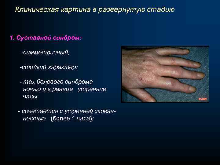 Клиническая картина в развернутую стадию 1. Суставной синдром: -симметричный; -стойкий характер; - max болевого
