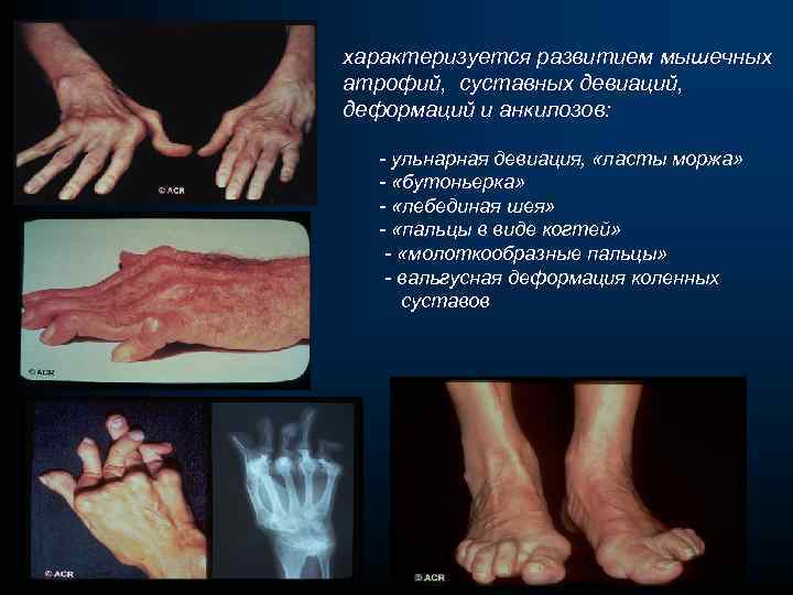 характеризуется развитием мышечных атрофий, суставных девиаций, деформаций и анкилозов: - ульнарная девиация, «ласты моржа»