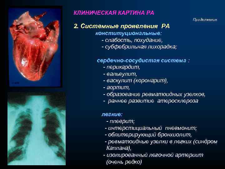 КЛИНИЧЕСКАЯ КАРТИНА РА Продолжение 2. Системные проявления РА конституциональные: - слабость, похудание, - субфебрильная