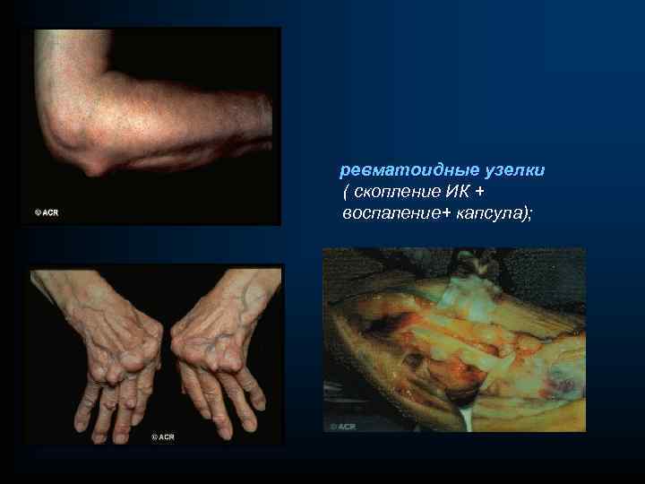 ревматоидные узелки ( скопление ИК + воспаление+ капсула); 