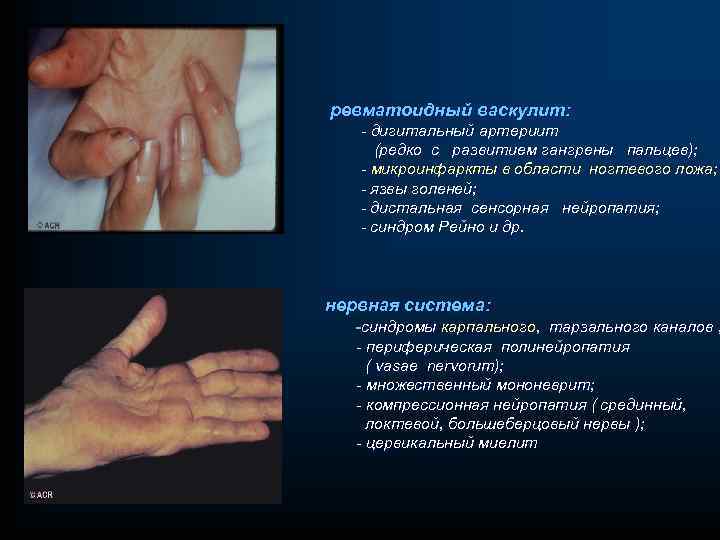 ревматоидный васкулит: - дигитальный артериит (редко с развитием гангрены пальцев); - микроинфаркты в области
