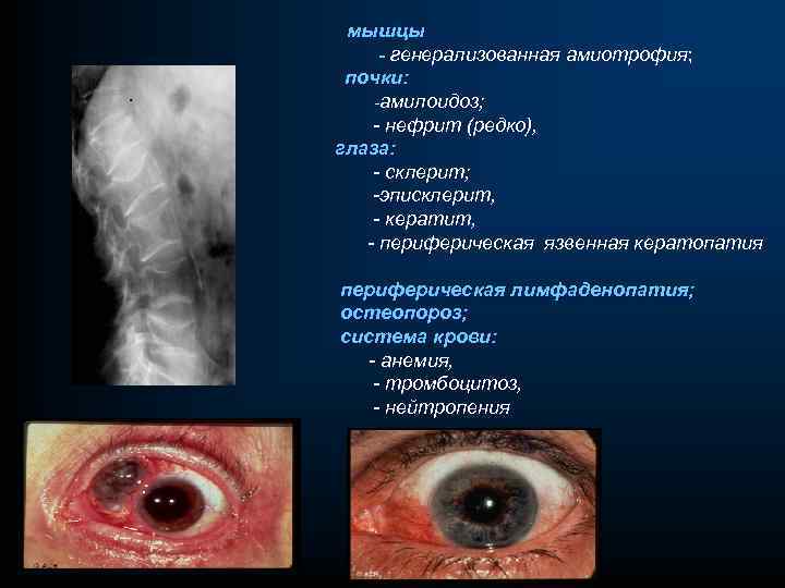 мышцы - генерализованная амиотрофия; почки: -амилоидоз; - нефрит (редко), глаза: - склерит; -эписклерит, -
