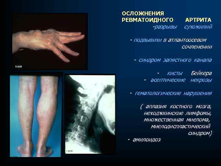 ОСЛОЖНЕНИЯ РЕВМАТОИДНОГО -разрывы АРТРИТА сухожилий - подвывихи в атлантоосевом сочленении - синдром запястного канала