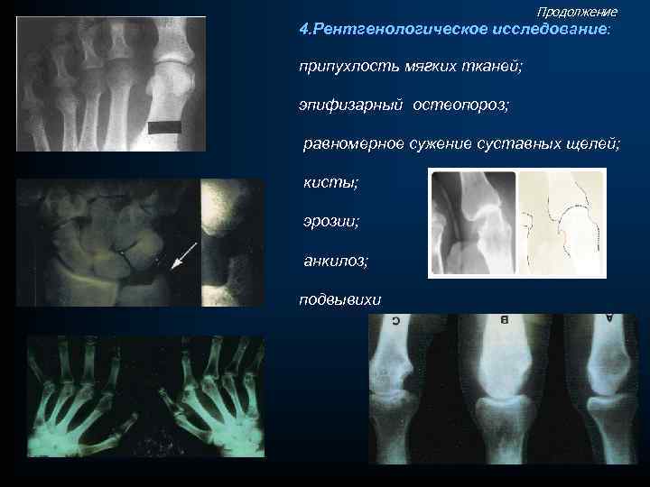 Продолжение 4. Рентгенологическое исследование: припухлость мягких тканей; эпифизарный остеопороз; равномерное сужение суставных щелей; кисты;