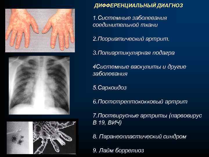 ДИФФЕРЕНЦИАЛЬНЫЙ ДИАГНОЗ 1. Системные заболевания соединительной ткани 2. Псориатический артрит. 3. Полиартикулярная подагра 4