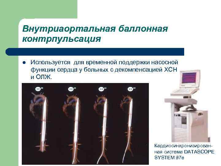 Внутриаортальная баллонная контрпульсация l Используется для временной поддержки насосной функции сердца у больных с