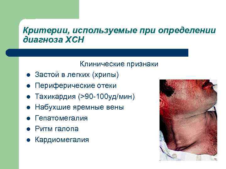 Критерии, используемые при определении диагноза ХСН l l l l Клинические признаки Застой в