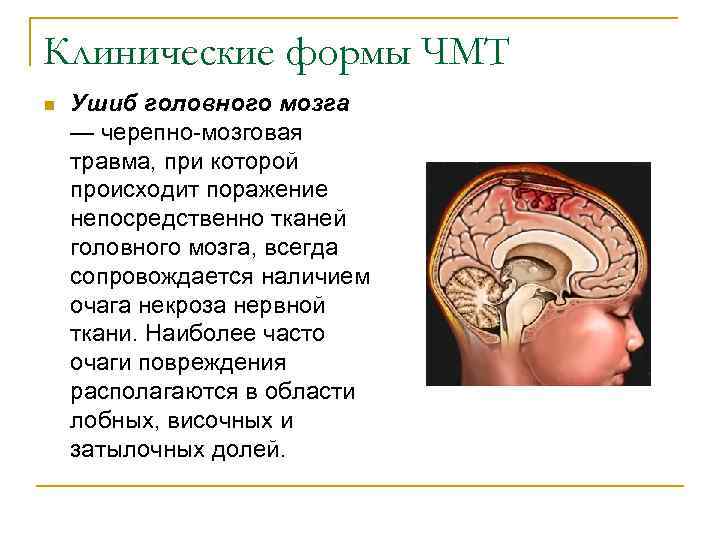 Повреждения головного мозга возникают. Черепно мозговая травма ушиб. Черепно мозговая травма ушиб мозга. Ушиб головного мозга средней степени. Клиническая картина черепно мозговой травмы.