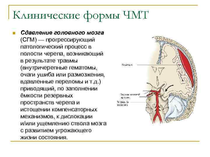 Клинические формы ЧМТ n Сдавление головного мозга (СГМ) — прогрессирующий патологический процесс в полости