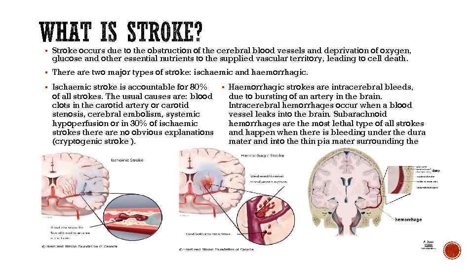 § Stroke occurs due to the obstruction of the cerebral blood vessels and deprivation
