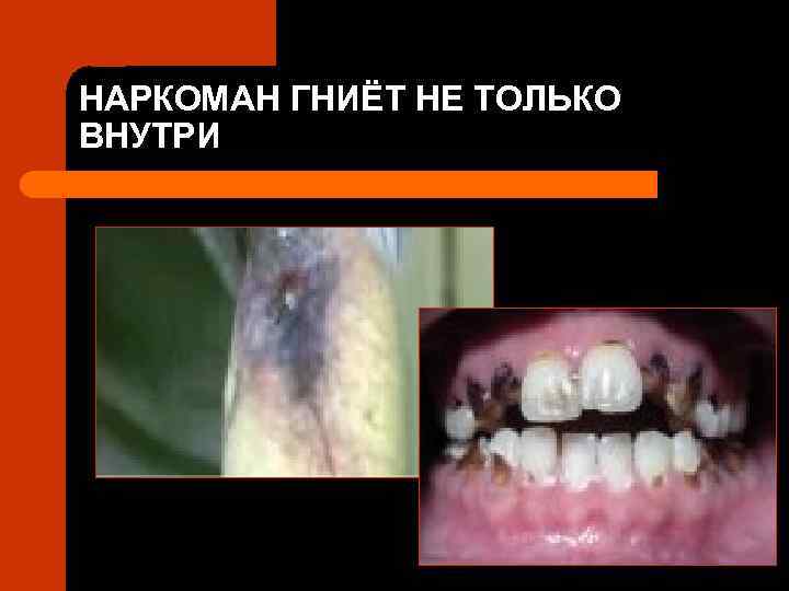 НАРКОМАН ГНИЁТ НЕ ТОЛЬКО ВНУТРИ 