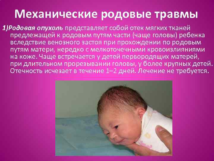 Механические родовые травмы 1)Родовая опухоль представляет собой отек мягких тканей предлежащей к родовым путям