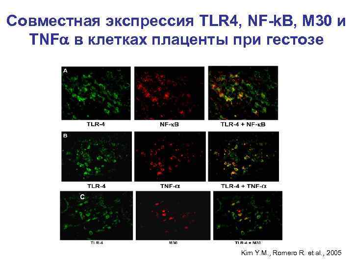 Совместная экспрессия TLR 4, NF-k. B, М 30 и TNF в клетках плаценты при