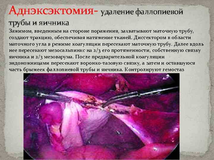 Аднэксэктомия- удаление фаллопиевой трубы и яичника Зажимом, введенным на стороне поражения, захватывают маточную трубу,