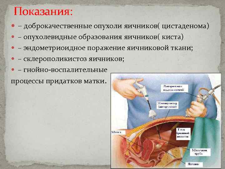 Показания: – доброкачественные опухоли яичников( цистаденома) – опухолевидные образования яичников( киста) – эндометриоидное поражение