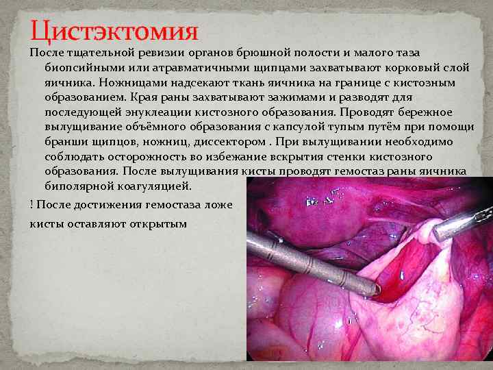 Цистэктомия После тщательной ревизии органов брюшной полости и малого таза биопсийными или атравматичными щипцами