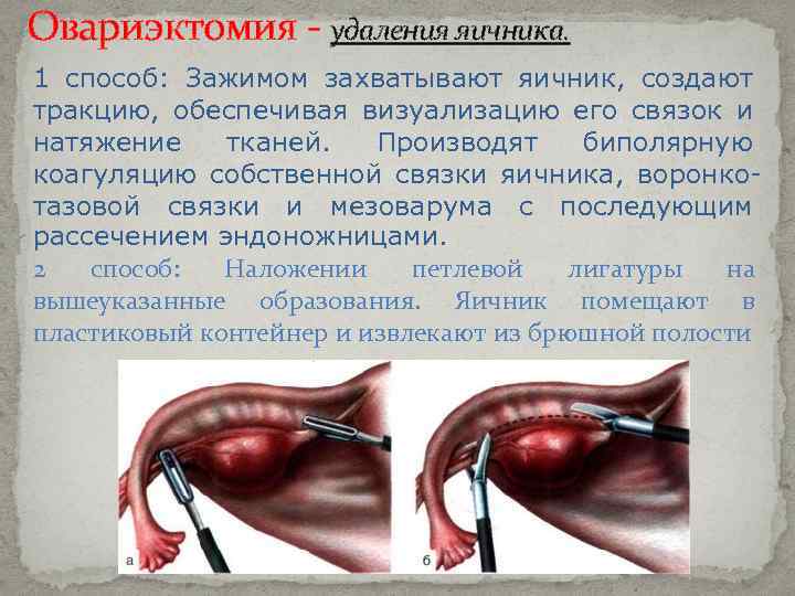 Овариэктомия - удаления яичника. 1 способ: Зажимом захватывают яичник, создают тракцию, обеспечивая визуализацию его