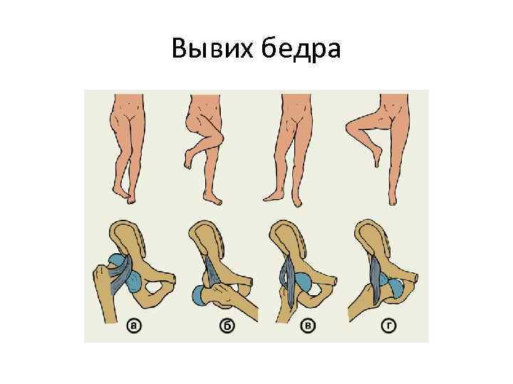 Вывих бедра