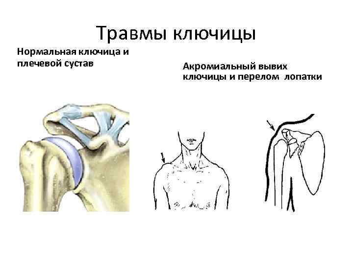 Переломы ключицы презентация