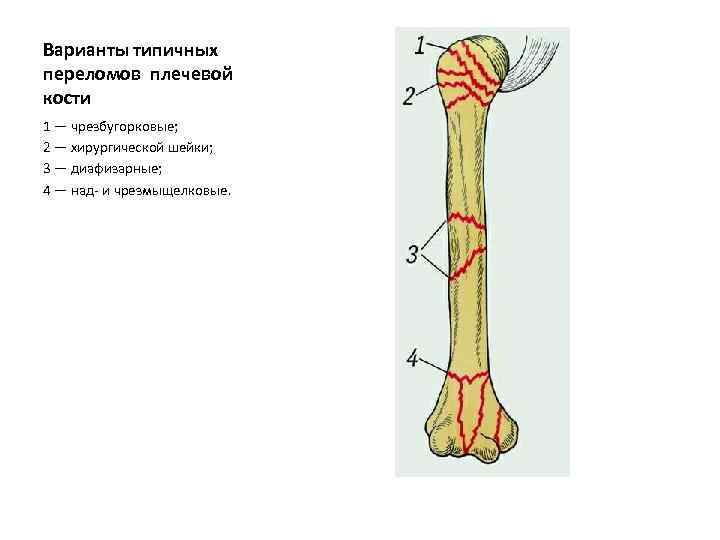 Проксимальные переломы плечевой кости